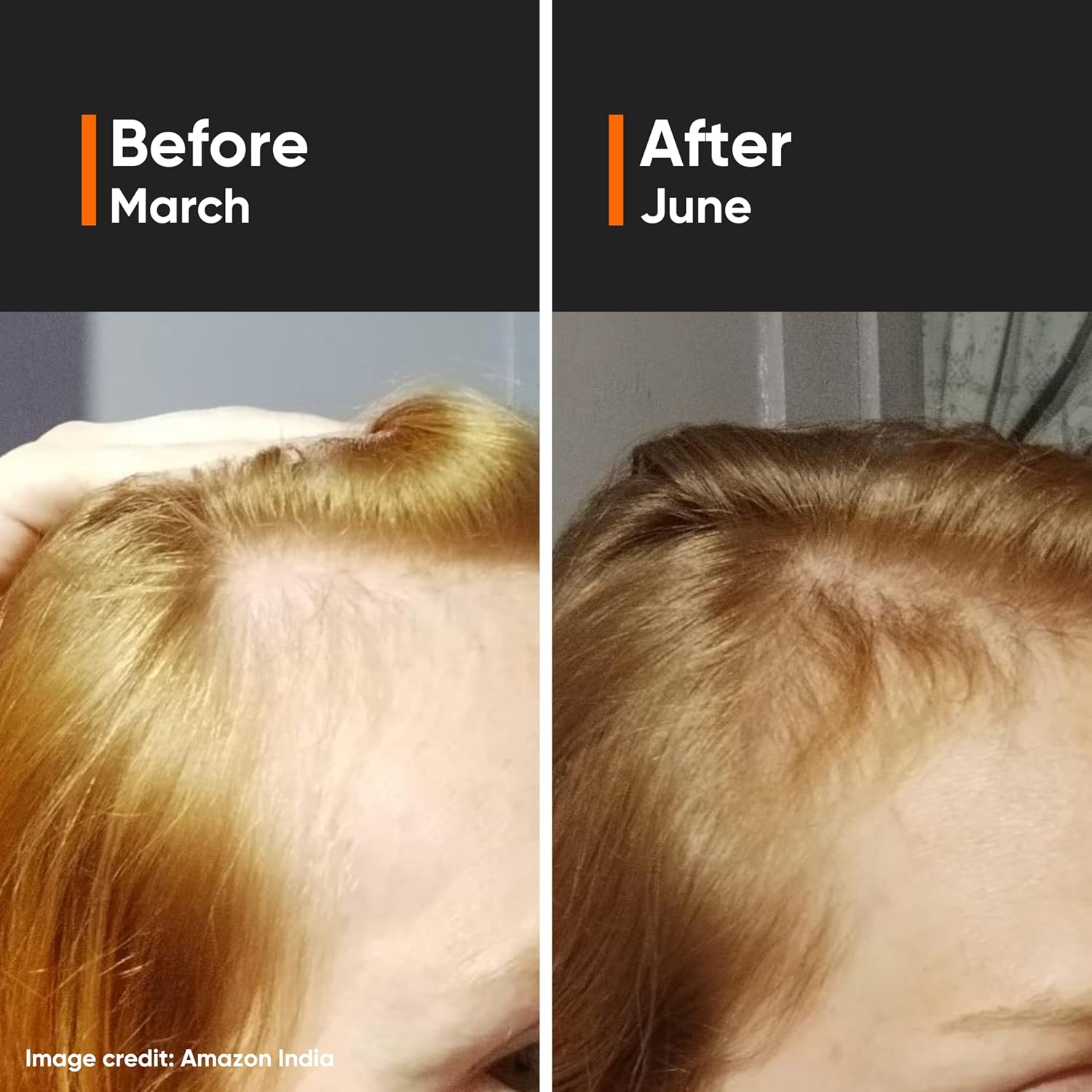 Minimalist Hair Density Serum 18% – Hair Fall Control Serum with Procapil, Capix